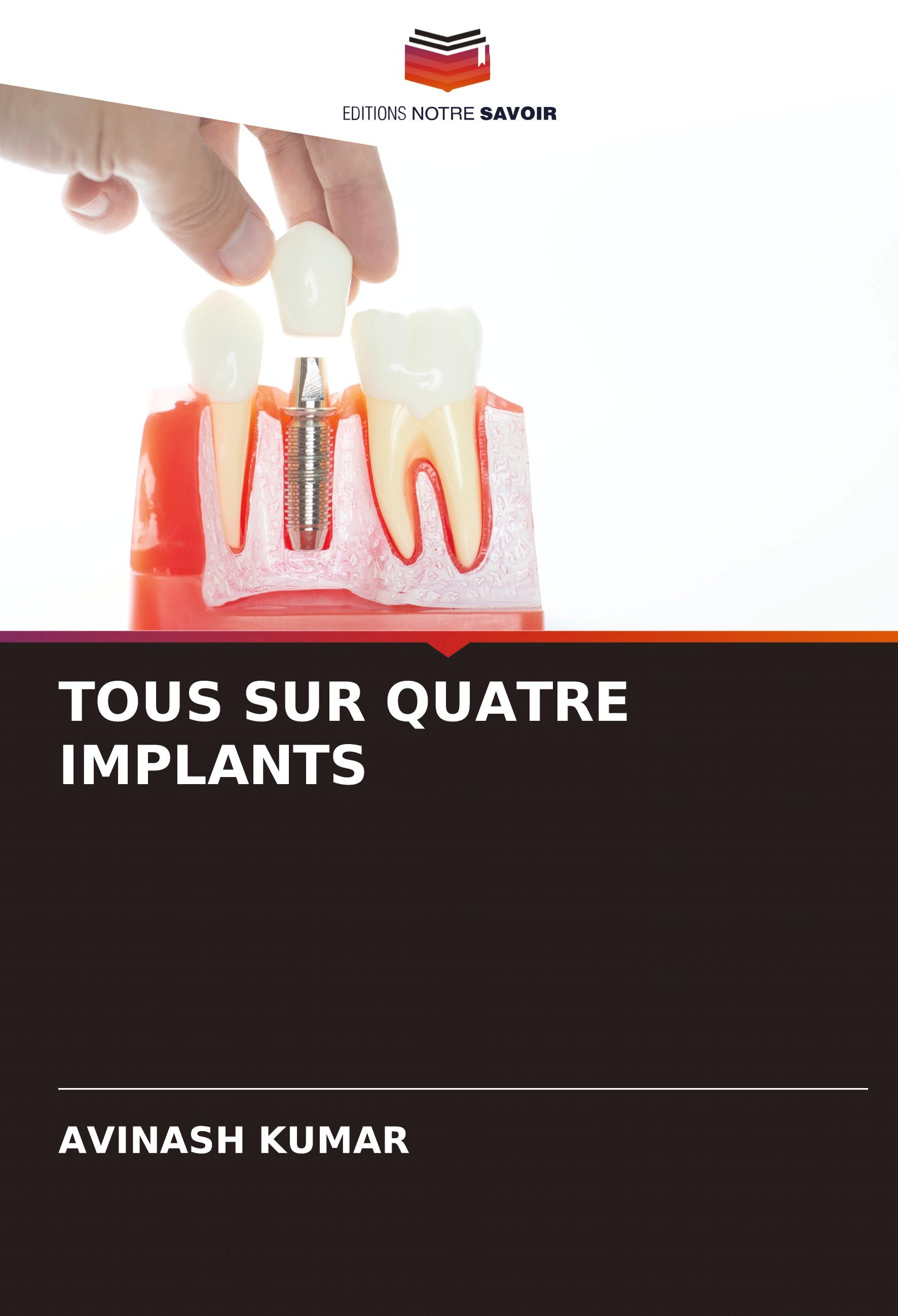 TOUS SUR QUATRE IMPLANTS