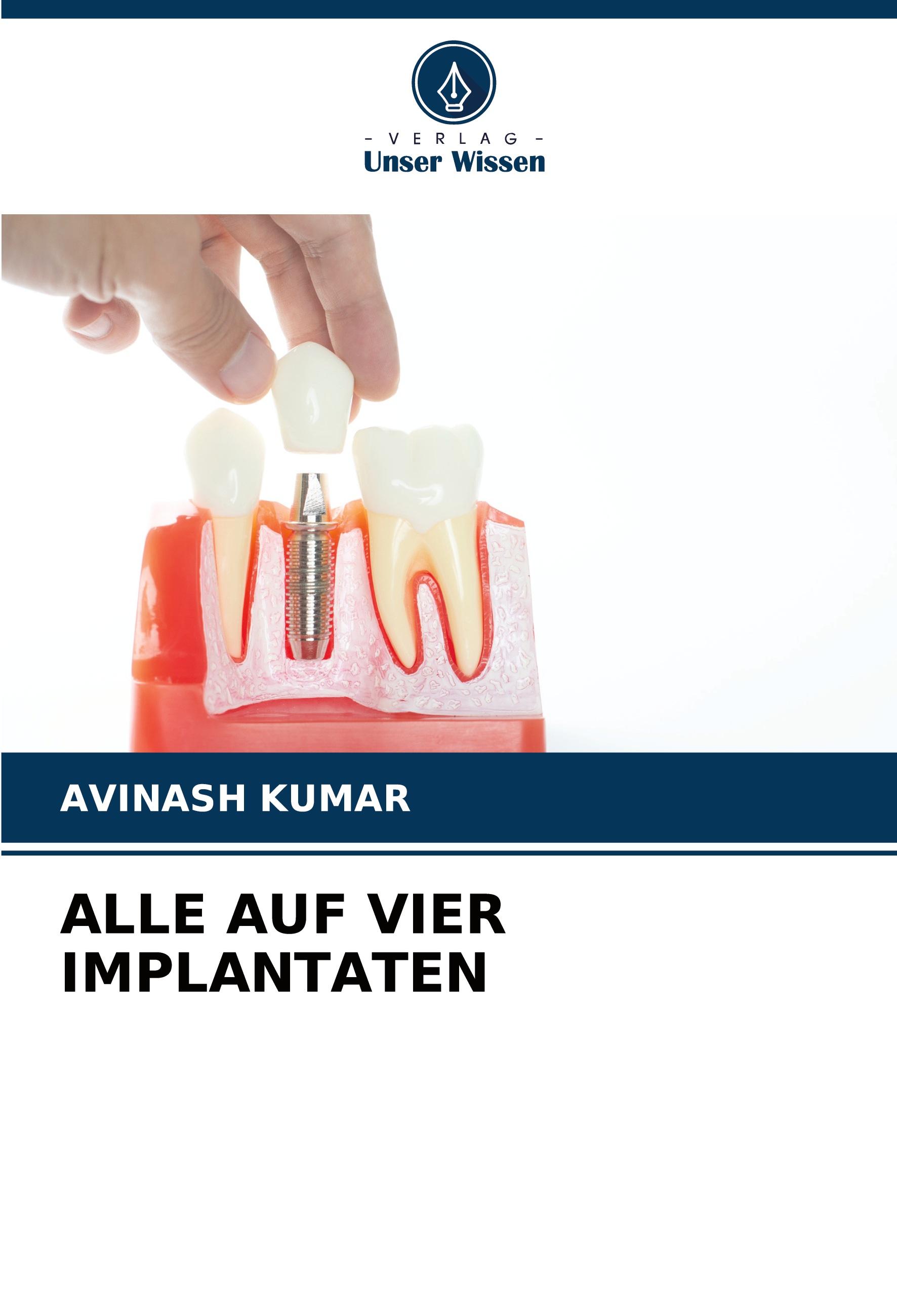 ALLE AUF VIER IMPLANTATEN