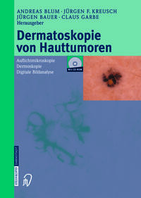Dermatoskopie von Hauttumoren