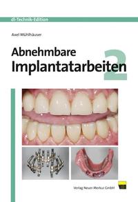 Abnehmbare Implantatarbeiten 2