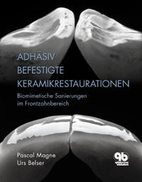 Adhäsiv befestigte Keramikrestaurationen im Frontzahnbereich