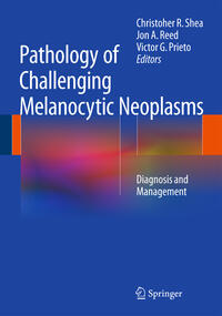 Pathology of Challenging Melanocytic Neoplasms